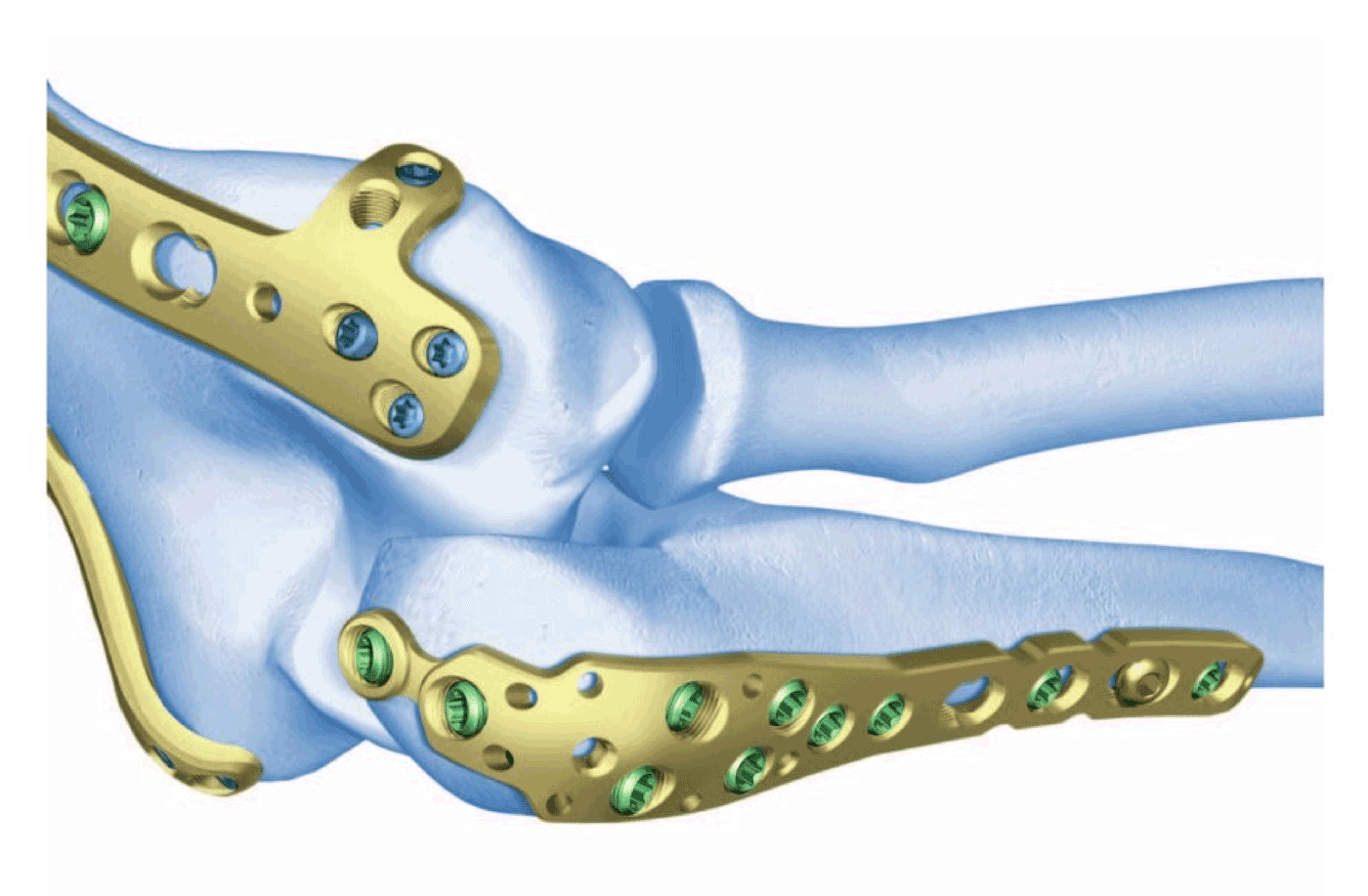 Proximal Ulna Locking Compression Plate Anatomical View
