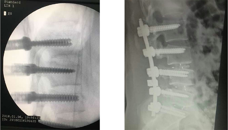 Spinal Surgery Fixation