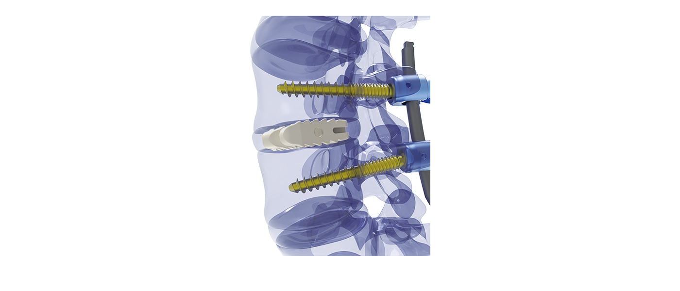 Pyramidal teeth for migration resistance