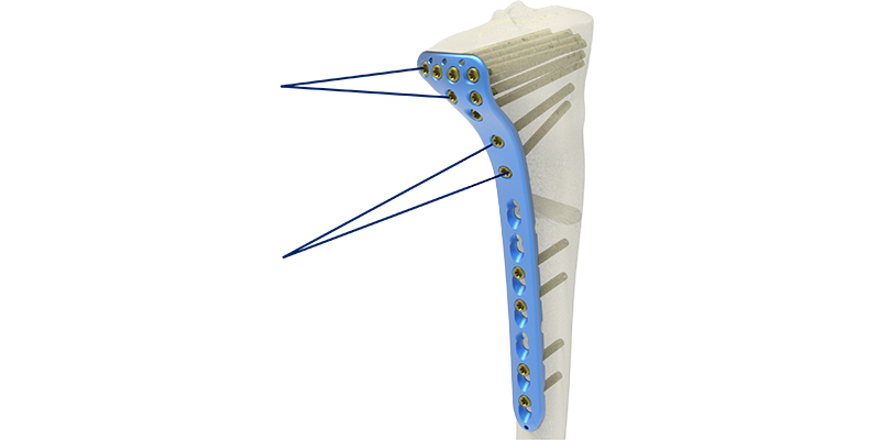 Proximal Lateral Tibia Rafting Rows Placement