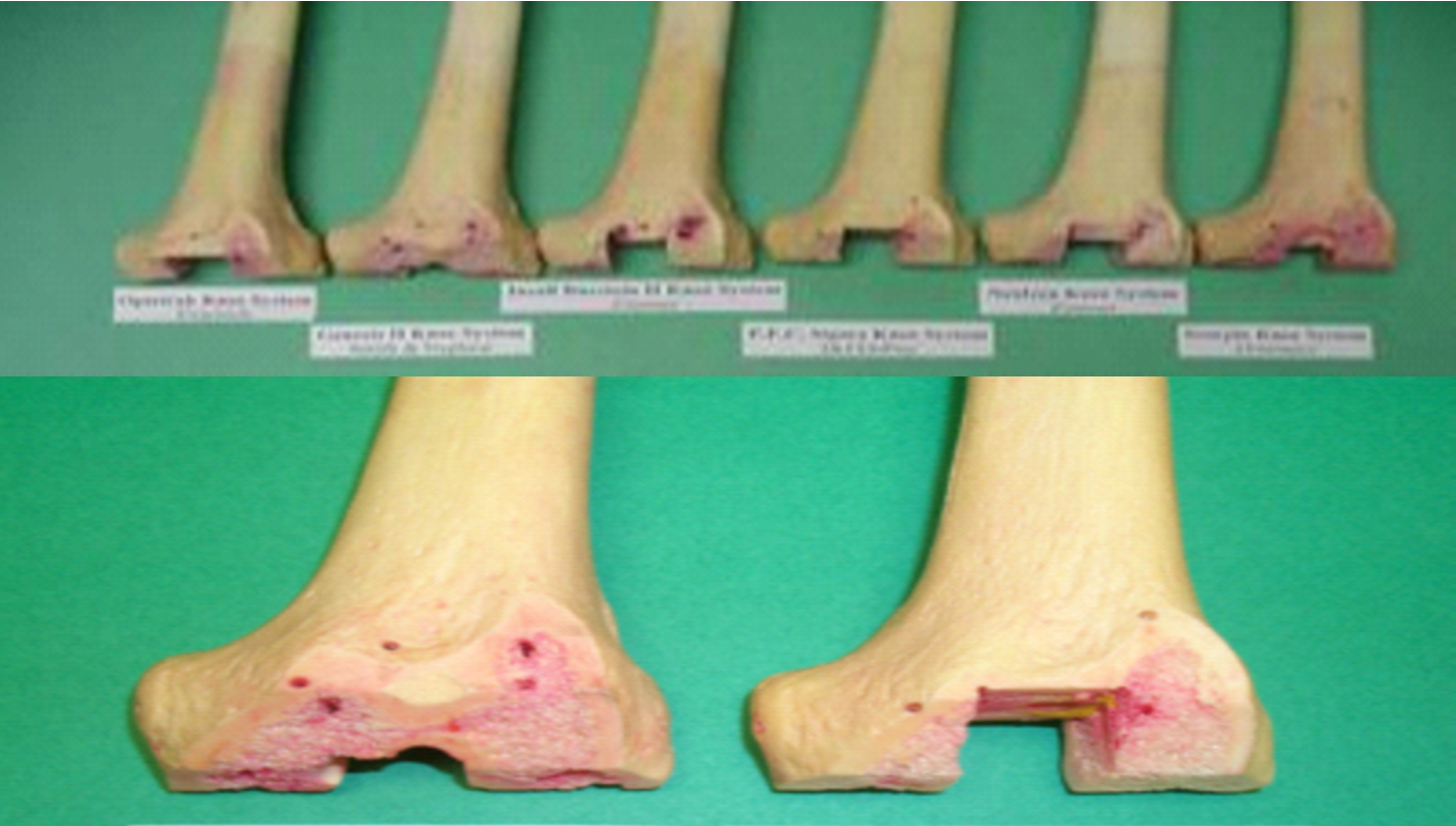 J curve femoral condyles design 1