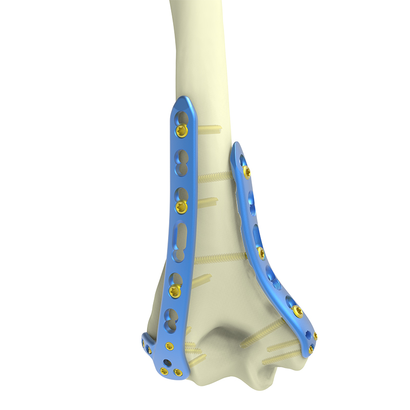 ODM Distal Posterolateral Humerus Locking Compression Plate (with Lateral Support) Product, Products