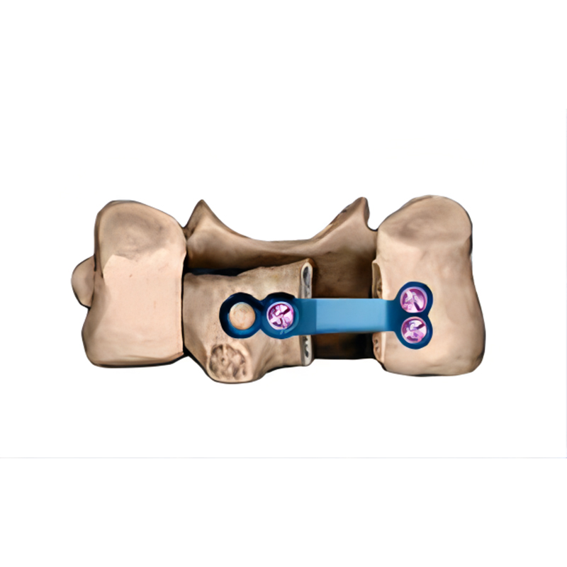 ODM Posterior Cervical Plate Fixation Dome Laminoplasty Plate Bone Implant Pricelist, Service