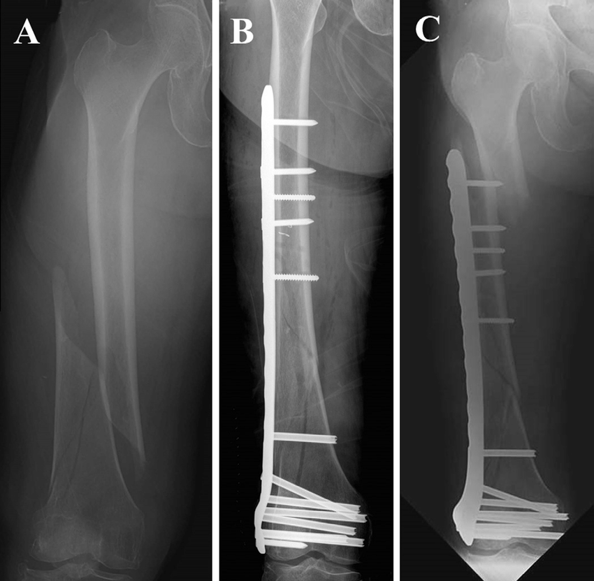 Distal Femur Plate System