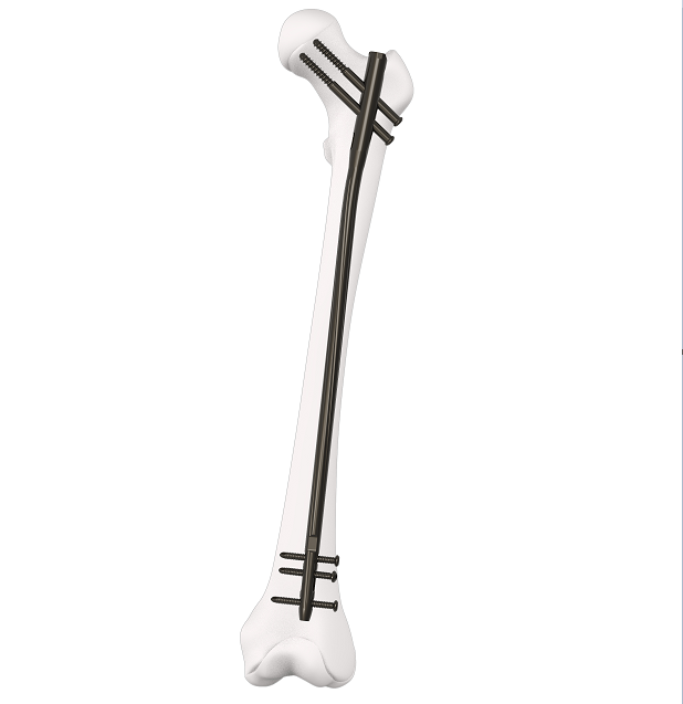 China MASFIN Femur Intramedullary Nail Implant Manufacturer, Manufacturers