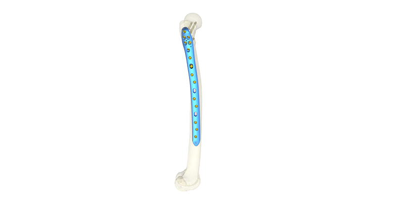 Surgical insertion and screw paths