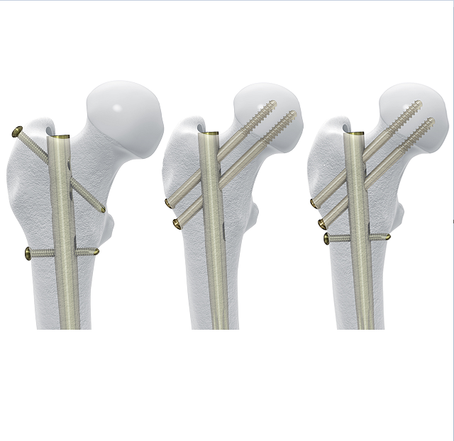 China MASFIN Femur Intramedullary Nail Implant Manufacturer, Manufacturers