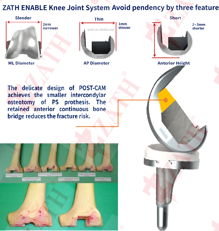 ODM Orthopedic titanium knee joint replacement prosthesis  Exporters, Service