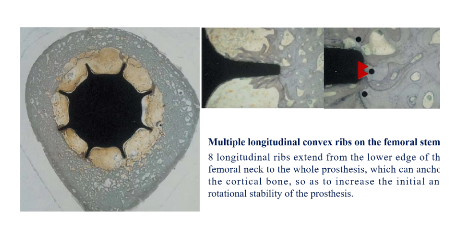 Hip Stem Prosthesis