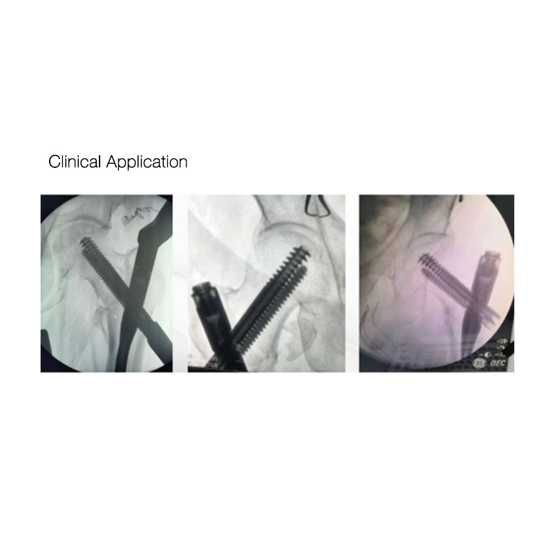 OEM Surgical Hospital Use InterZan Titanium Interlocking Nail for Femur Supplier, Factories