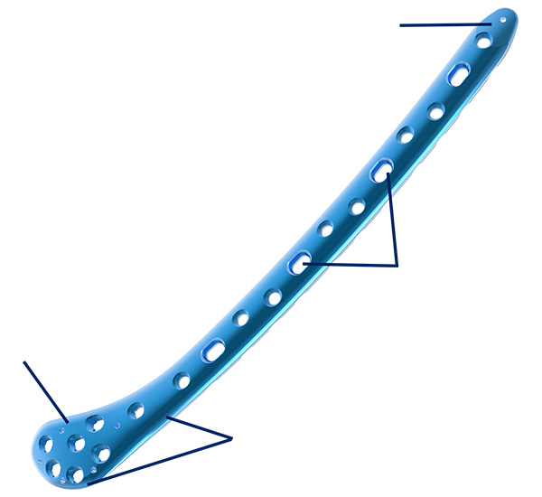 Distal Lateral Femur Plate Overview