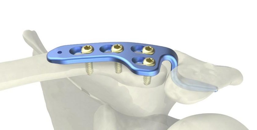 Anatomical Pre-contoured Profile