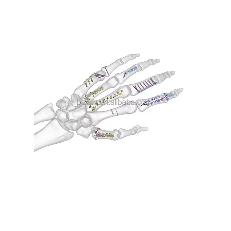 Best Hand Fracture Locking Plate System Exporter, Companies