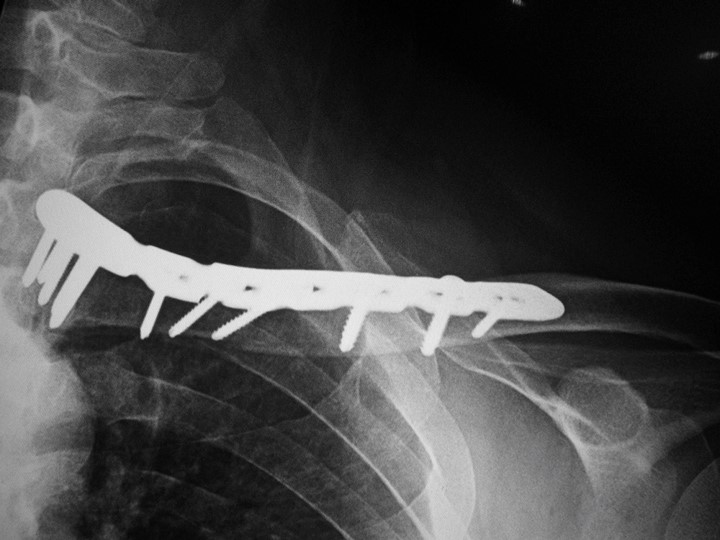 Wholesale Distal Clavicle Locking Compression Plate Manufacturers, Suppliers