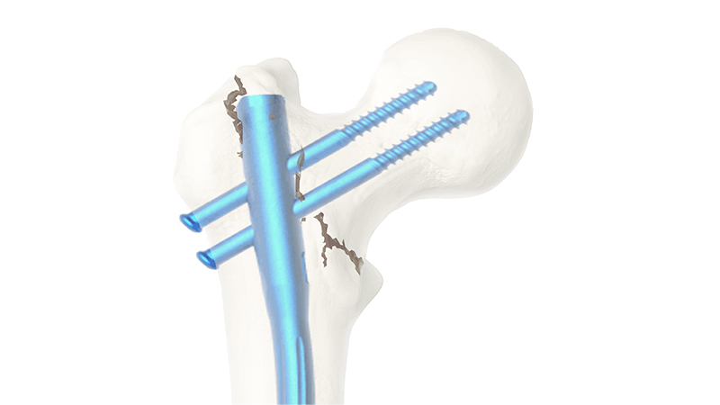 Femoral Nail Feature 5