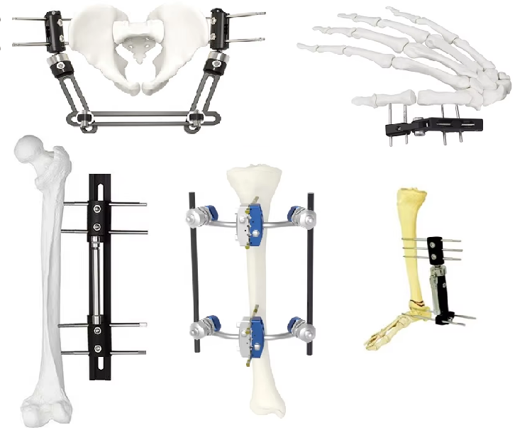 Discount Orthopedic stainless synthes external fixation fixator  Factories, Pricelist
