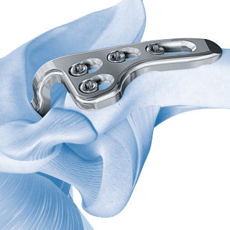 Buy Clavicle Hook Locking Compression Plate Manufacturer, Supplier