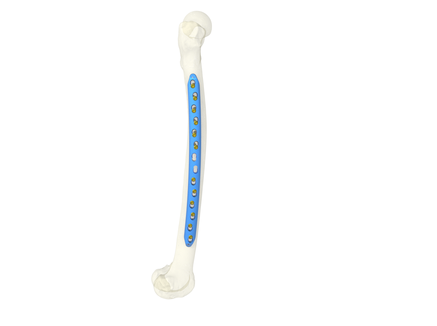 Famous Curved Femoral Shaft Locking Compression Plate Suppliers, Companies