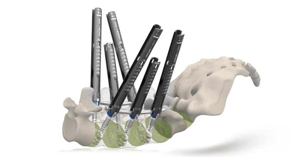 Minimally invasive posterior thoracolumbar 3-in-1 screw-rod system