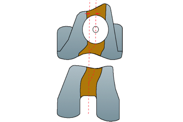 J curve femoral condyles design 2