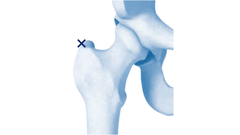 Femoral Nail Feature 3
