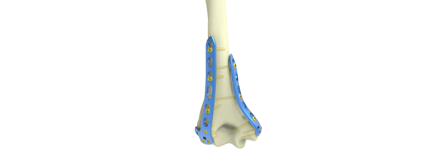 Buy Distal Medial Humerus Locking Compression Plate Factory, Exporters