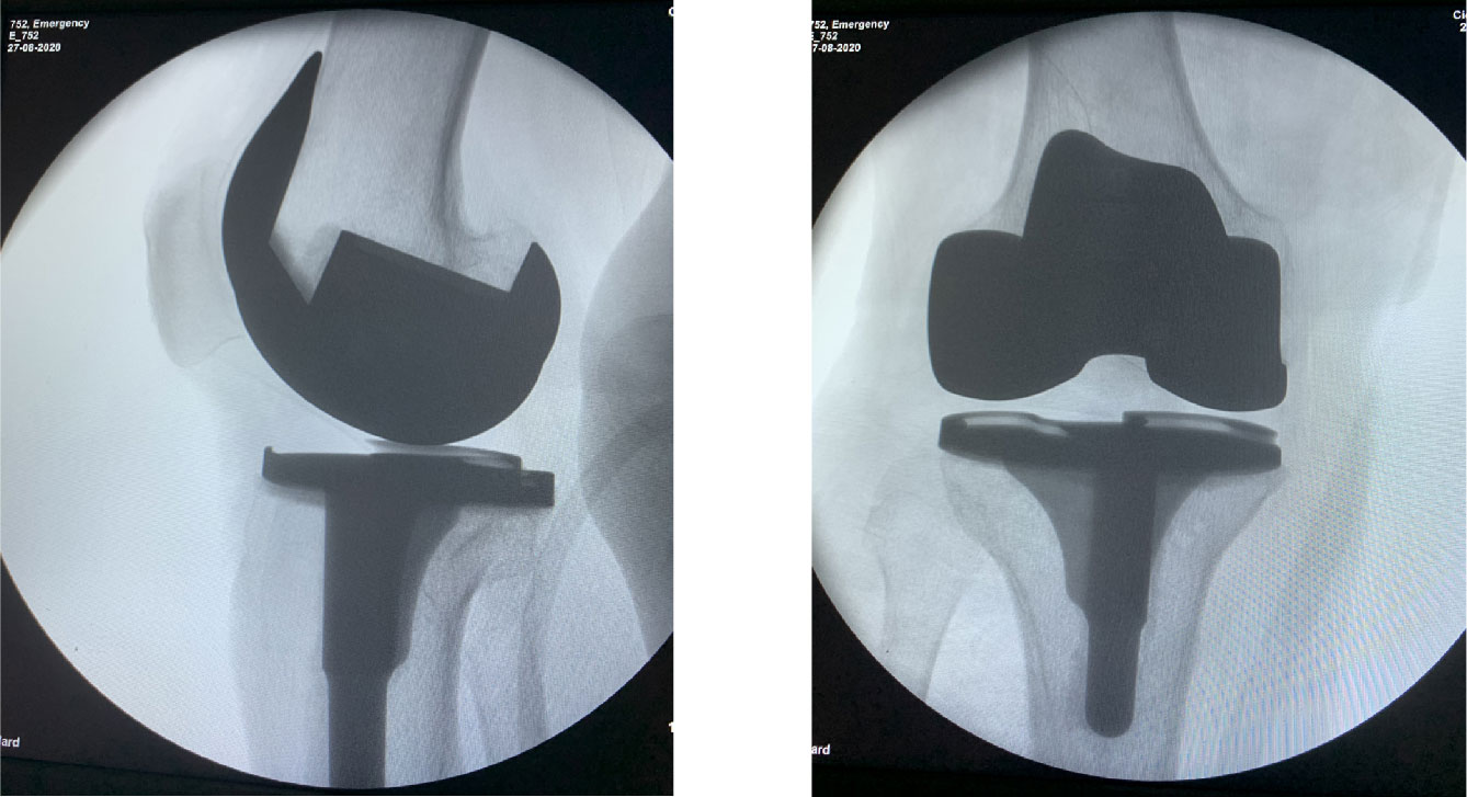 Knee Joint Rehabilitation and Recovery