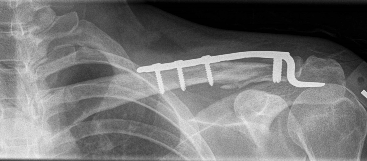 Lateral Clavicle Fixation Overview