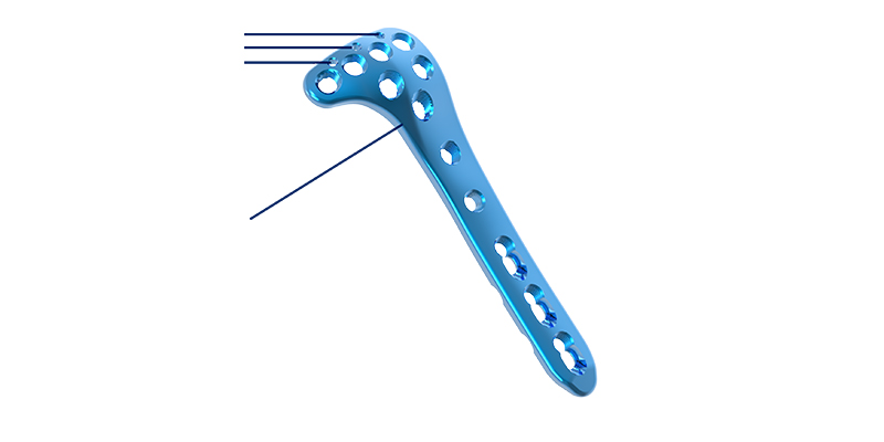 Proximal Lateral Tibia Anatomical Fit and Screw Locking System