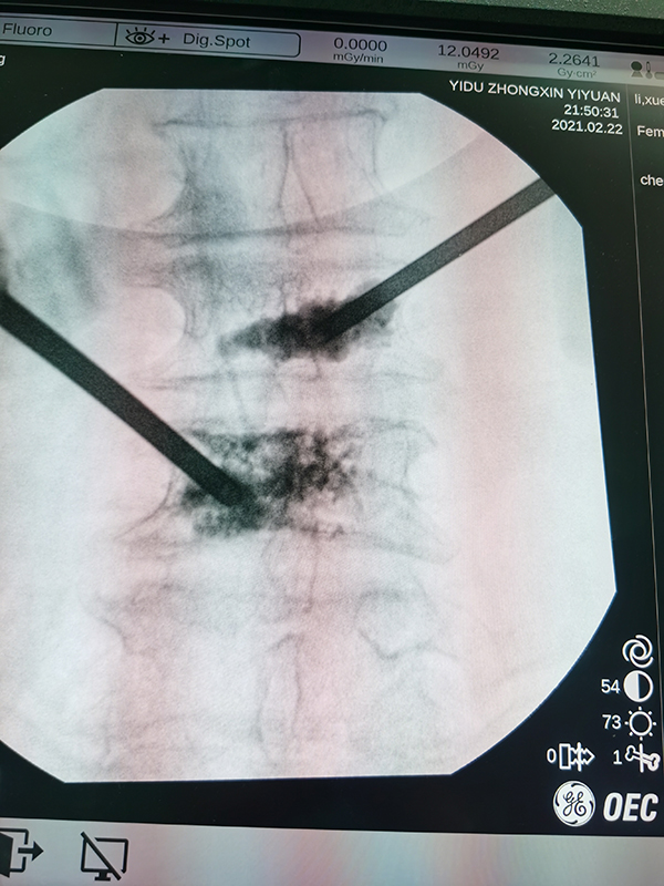 Vertebroplasty Kyphoplasty Equipment