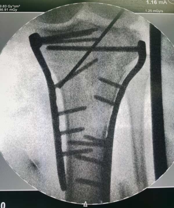Best Proximal Medial Tibia Locking Compression Plate I Pricelist, Product
