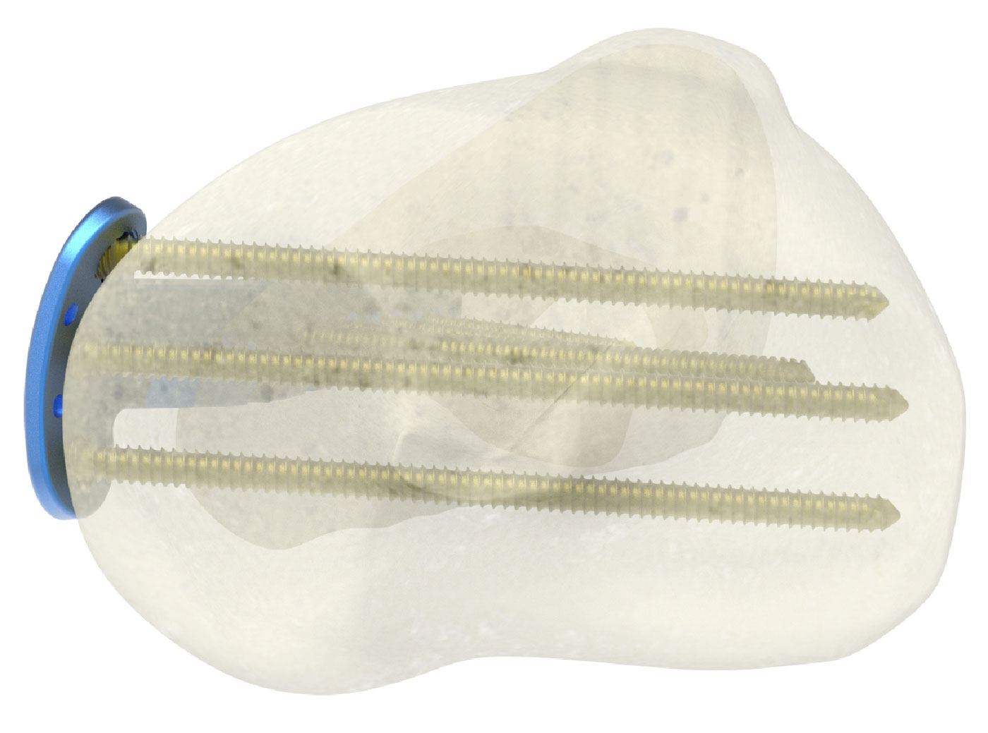 Tibia Locking Plate Screw Hole Pattern