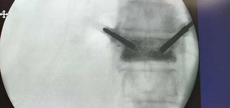 Spine Surgical System