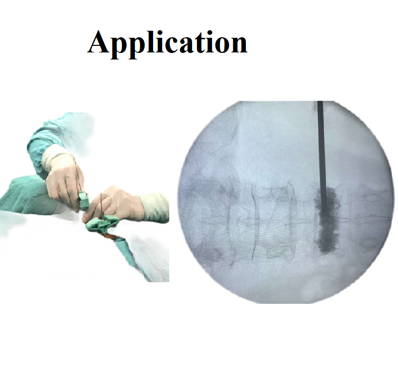Famous Professional manufacturer PKP layer Vertebroplasty instruments set kit  Exporters, Products