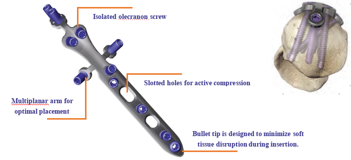 Proximal Ulna ISC Locking Compression Plate Anatomical View