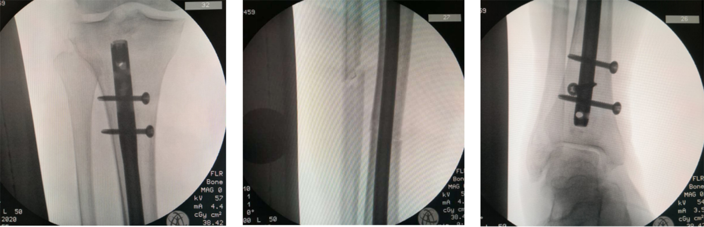 Distal and proximal locking alignment