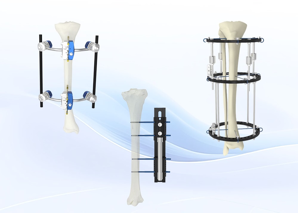 External Fixation