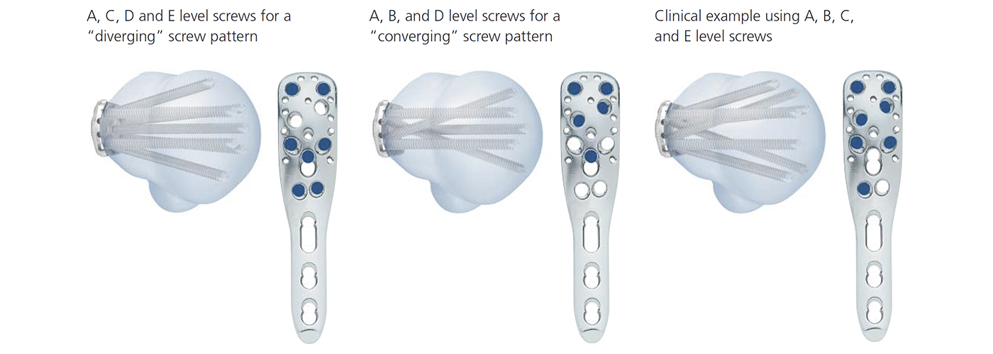 Multi-fragment Proximal Humerus Fixation