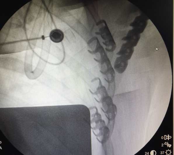 Rib Claw Fixation Example