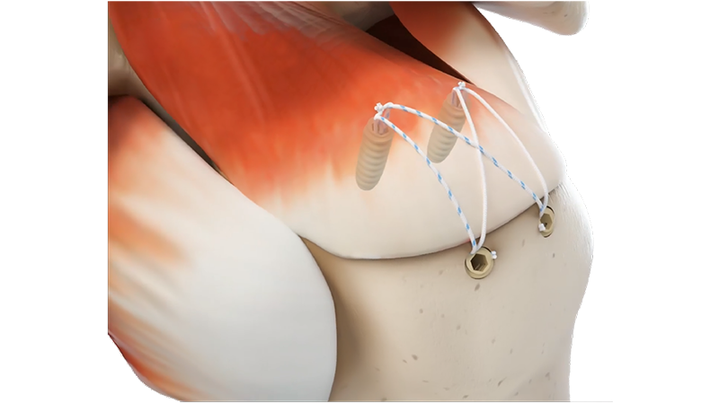SuperFix P Knotless Suture Anchor Detail 1