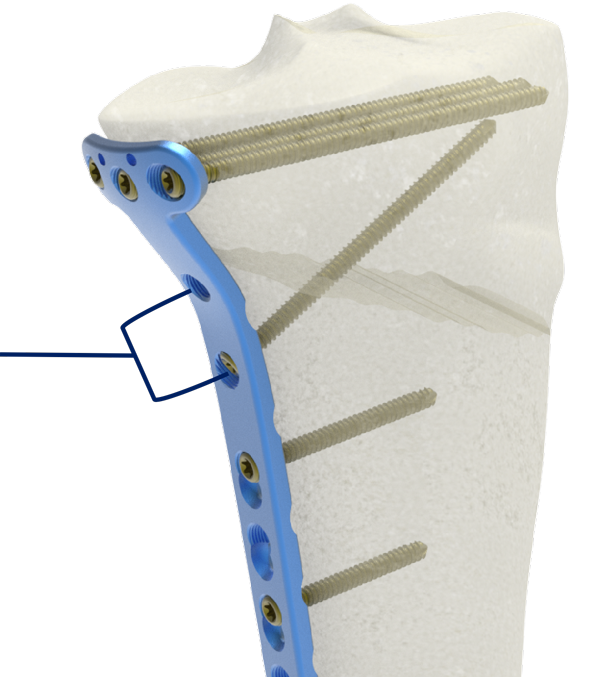 Best Proximal Medial Tibia Locking Compression Plate I Pricelist, Product