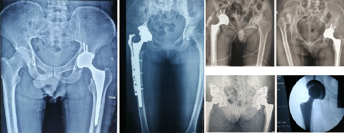 Prosthesis Product Overview 4