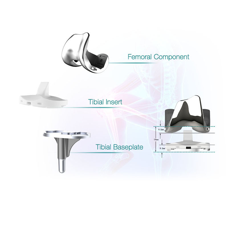 Buy High Quality Titanium Total Knee Joint Replacement Implants  Pricelist, Companies