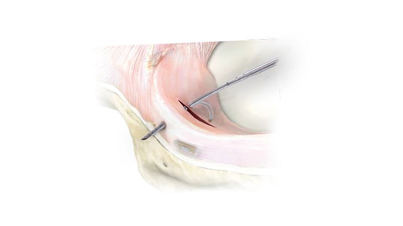 All-inside Meniscal Repair Device Application