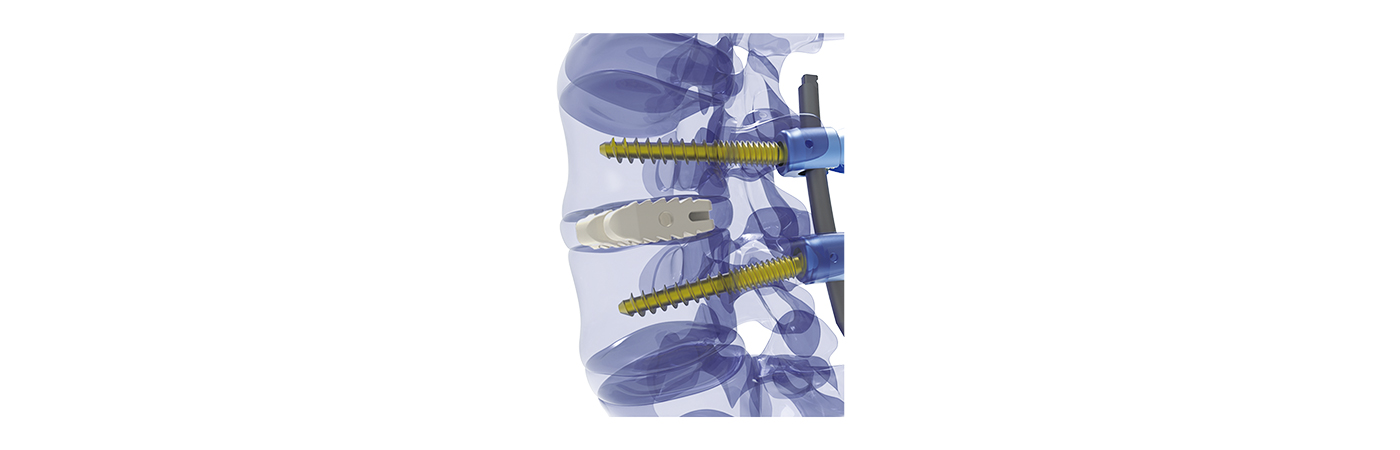 Convex shape for anatomical fit