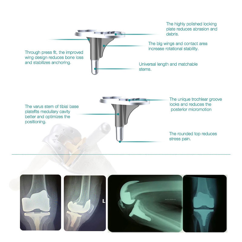 Buy High Quality Titanium Total Knee Joint Replacement Implants  Pricelist, Companies