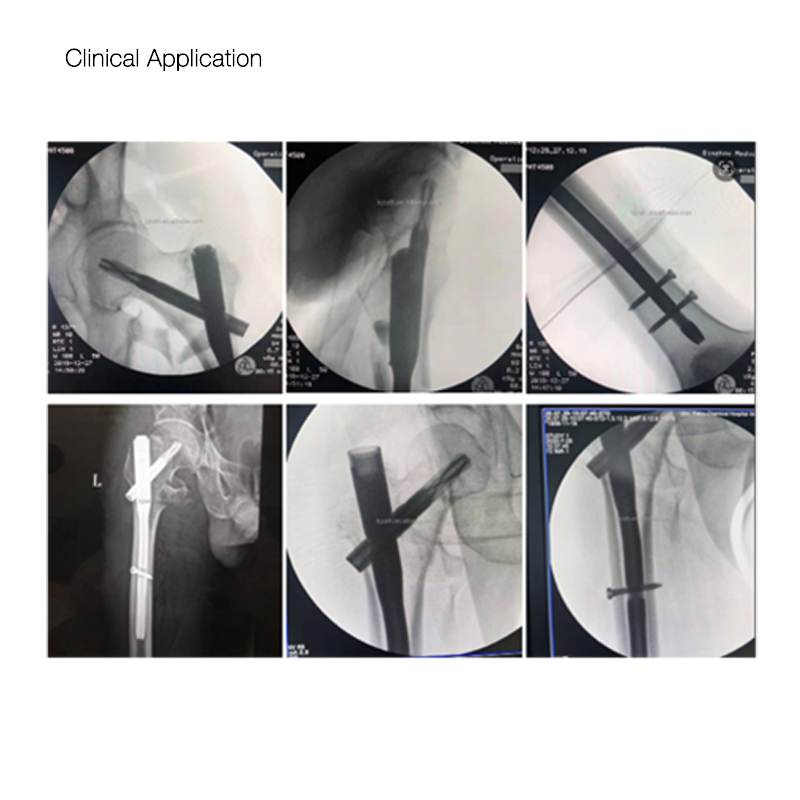 Cheap Surgical Orthopedic Implant Titanium ZAFIN Intramedullary Nail Pricelist, Exporters