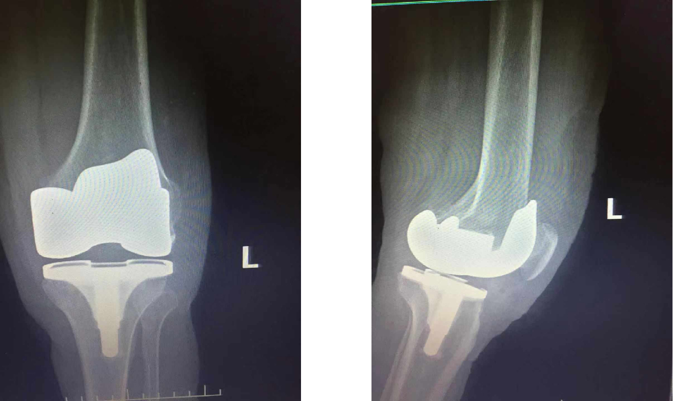 Tibial Insert Indications