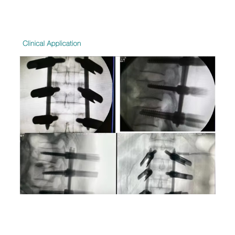 OEM High Quality ZATH HE Minimal Invasive Spine Pedicle Screw Manufacturers, Exporters