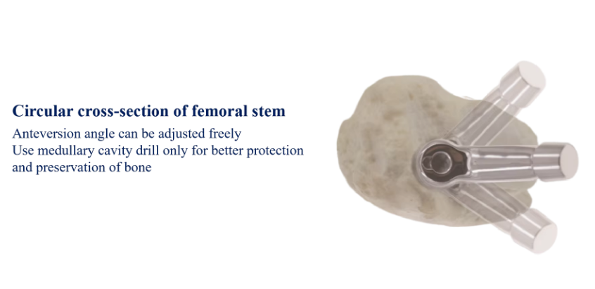 DDS Hip Stem